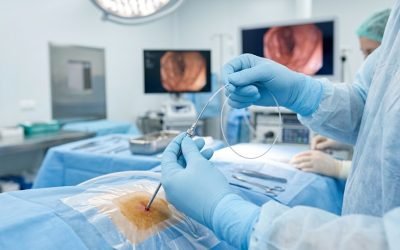 A surgeon's gloved hands threading a thin guidewire through a needle into a patient's prepped abdomen during a PEG tube placement, with monitors showing the endoscopic view inside the stomach.