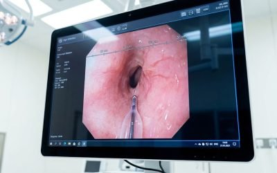 A large monitor in a procedure room displaying a live high-definition endoscopic view inside the esophagus with centimeter distance markers, and a dilation catheter visible at the bottom of the image.