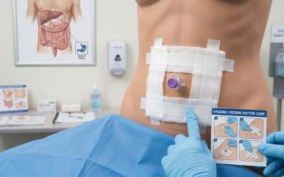 A patient's abdomen with a low-profile PEG feeding button secured by gauze dressing and medical tape, while gloved hands hold a hygienic feeding button care instruction card, with a digestive system chart on the wall.
