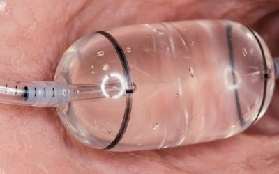 Endoscopic close-up of a transparent dilation balloon inflated inside the esophagus, with the pink esophageal mucosa visible around the balloon.